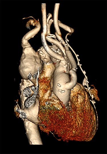 CT reconstruction illustrating a debranched left common carotid artery and subclavian artery with double coronary artery bypass graft (left internal mammary artery to left anterior descending, and saphenous vein T graft to obtuse marginal artery).