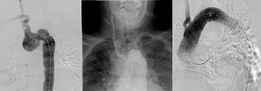 Angiography illustrating Kommerell’s diverticulum before and after deployment of Amplatzer plug (A) to right subclavian and thoracic aortic stent graft (B).