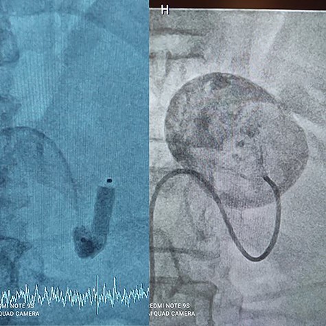 Balloon Proximal control.