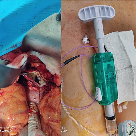 Hybrid surgery: Aneurysm sac (Left), Angiography sheath and inflator (Right).