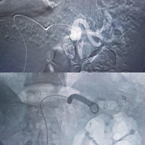 Coil embolization.