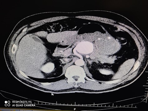 CTA of proximal splenic aneurysm.