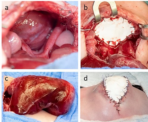The anterior thoracic defect (a) was covered with a Gore-Tex-Patch (b). After mobilization from the anterior mediastinal space, the liver assumed an irregular shape not allowing abdominal wall closure (c). The defect was temporarily covered by a skin Gore-Tex -Patch (d).