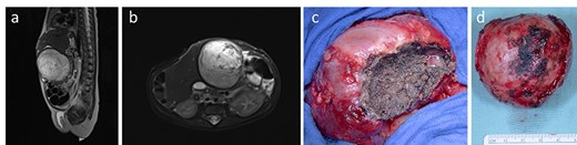 MRI showing the vascularized tumor originating from the liver, occupying the precaval space and protruding outside the abdominal wall level (a, b). At surgery, a cleavage sheet between liver and the mass (c) allowed an easy and complete resection of the tumor (d)