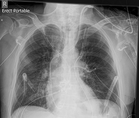 Chest X-ray demonstrating placement of the four chest drains.
