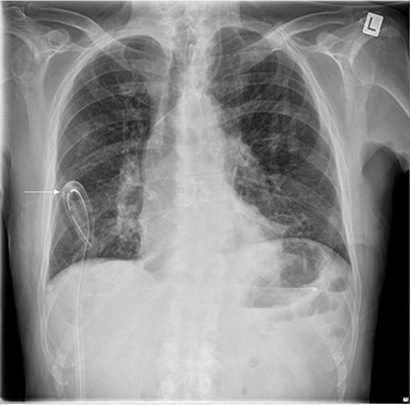 Chest X-ray demonstrating kinking of the chest tube around a rib on the right side.