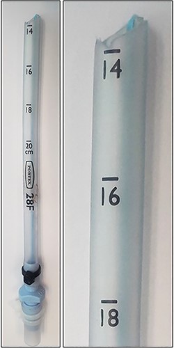 A 28 F chest tube that became severed at the 14-cm mark upon attempted removal.