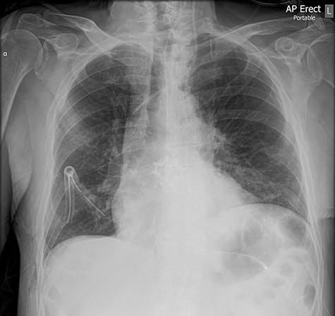 Chest X-ray demonstrating the retained chest tube segment on the right side.
