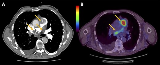 (A) Chest computed tomography pulmonary angiogram showing intraluminal filling defects in the RVOT, pulmonary trunk and left PA. (B) PET showing the uptake of fluorodeoxyglucose within the RVOT and extending into both left and right PAs.