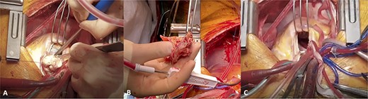Intraoperative photos showing (A) bulky tumour being in the RVOT and main PA, (B) main part of tumour resected from PA and (C) complete cytoreduction.