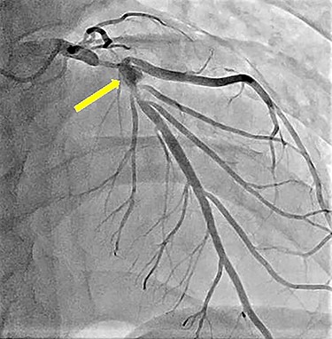 Preoperative left coronary angiography showing the coronary artery aneurysm in the left anterior descending artery (arrow) and severe stenosis at its distal and proximal sides.