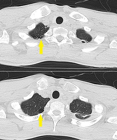Lung CT showing bullae on the pulmonary apex of the left lung (arrows).