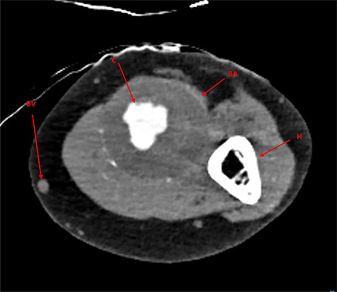 CTA imaging of brachial artery aneurysm of the left arm; BA, brachial aneurysm; BV, basilic vein; C, contrast through aneurysm lumen; H, humerus.