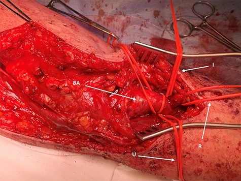 Distal operative site; the aneurysm is identified with branching vessels controlled with slings; BA, brachial aneurysm; R, radial artery controlled; U, ulnar artery controlled; I, interosseus controlled.