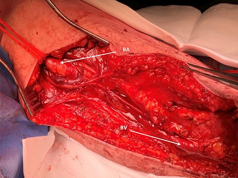 Proximal operative site; the aneurysmal proximal end of the brachial artery is seen (BA) and looped for control; BV, aneurysmal-associated basilic vein is seen and can be appreciated.
