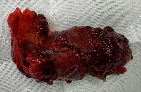 Thrombus resected from the aneurysm sac once opened.