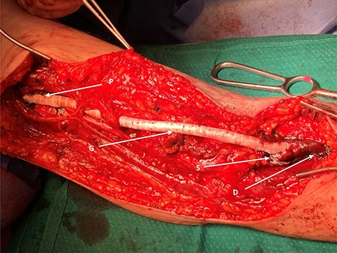 PTFE graft fashioned end-to-end as aneurysm replacement; G, graft made of PTFE; P, proximal end; D, distal end; S, surgicel applied to either end, intra-op for haemostasis.