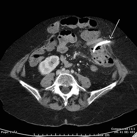 Axial computed tomography (CT) image demonstrating perforation of a migrated biliary stent into the anterior abdominal wall.