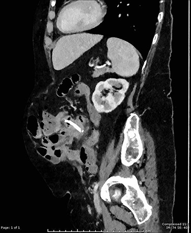 Sagittal CT image showing migrated biliary stent perforation through jejunum located within a large anterior abdominal wall hernia.