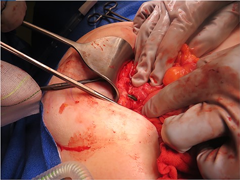 Intra-operative photograph demonstrating a biliary stent perforating through jejunum and lodging into the anterior abdominal wall.