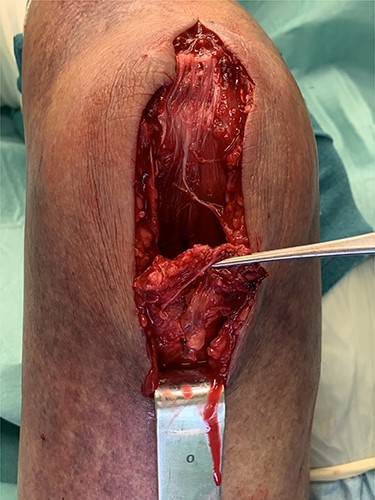 Intraoperative tendon rupture.