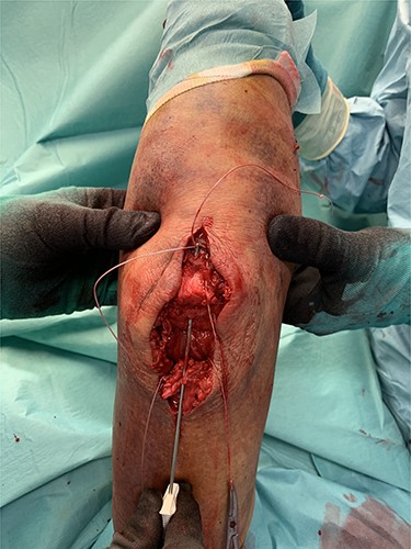 Intraoperative transosseous refixation.