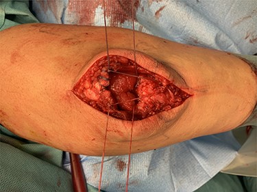 Intraoperative after transosseous refixation.