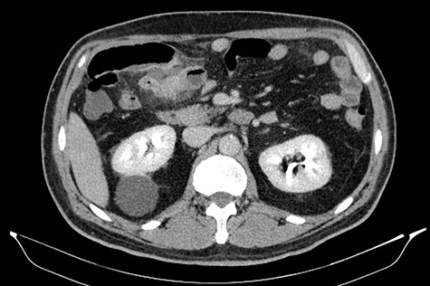 Short segment of small bowel with inflammatory signs and localized free peritoneal fluid (CT scan).