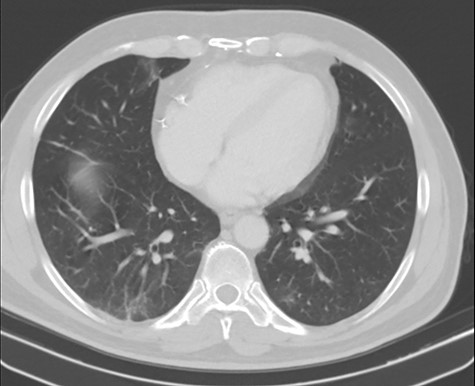 Residual ground-glass opacities related to COVID-19 (CT scan).