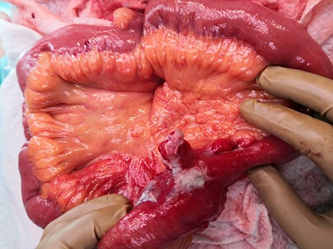 Intraoperative Meckel’s diverticulitis.