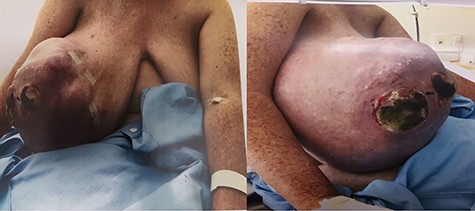 The right breast mass with two ulcerating wounds at centre, stretched-out erythematous skin.
