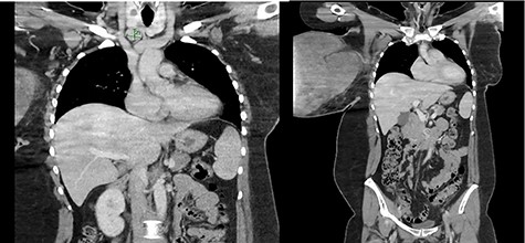 Enlarged supraclavicular lymph node and partially imaged massive tumour in the right breast.