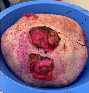 Excised mass measuring 310 × 200 × 240 mm.