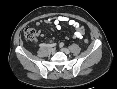 CT of the abdomen and pelvis demonstrating acute appendicitis.