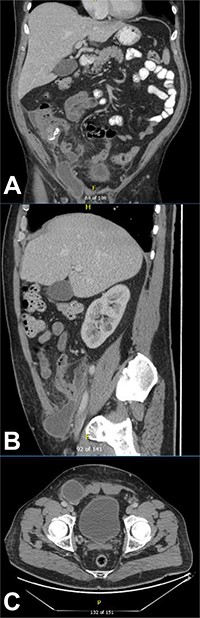 CT of the abdomen and pelvis demonstrating a fluid collection/abscess extending into a right inguinal hernia sac in (A) coronal (B) sagittal and (C) apical planes.