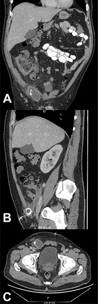 CT of the abdomen and pelvis demonstrating a reduction in size of the fluid collection/abscess in the inguinal hernia sac in (A) coronal (B) sagittal and (C) apical planes.