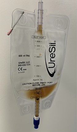 Serous fluid drained after 1 week.