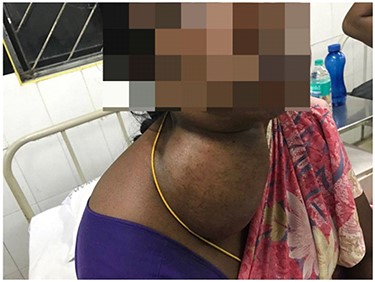 Lateral mass in the neck.