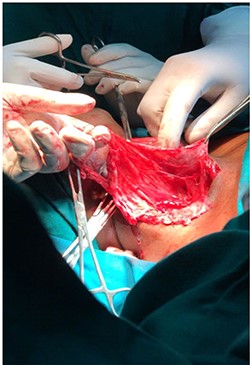 Image showing dissection of the tissues around the mass.