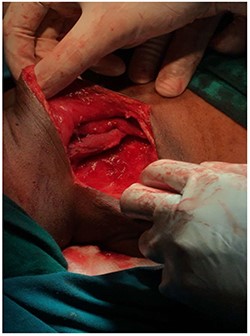 Image showing the mass after dissection.