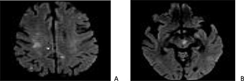 Cerebral magnetic resonance imaging (MRI): sections in diffusion at 1000 b showing punctiform cortico-subcortical (A) and mesencephalic (B) lesions related to embolic infarcts.