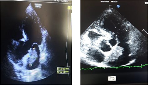 Transthoracic echographay: showing a left intra-atrial mass based on a large implantation in the inter-atrial septum.