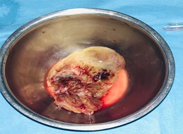 Operative view showing the entire mass excised.