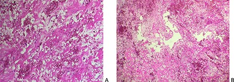 Cardiac myxoma displaying stellate cells with abundant myxoid and hemorrhagic stroma (A: Hex100, B: Hex200).