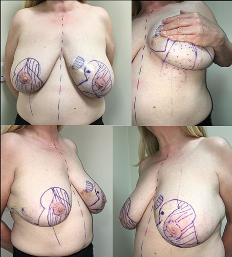 Pre-operative markings. Bilateral-Wise pattern skin reduction markings, showing anterior, oblique and inferior views. Note is made of significant size asymmetry between right and left breast.