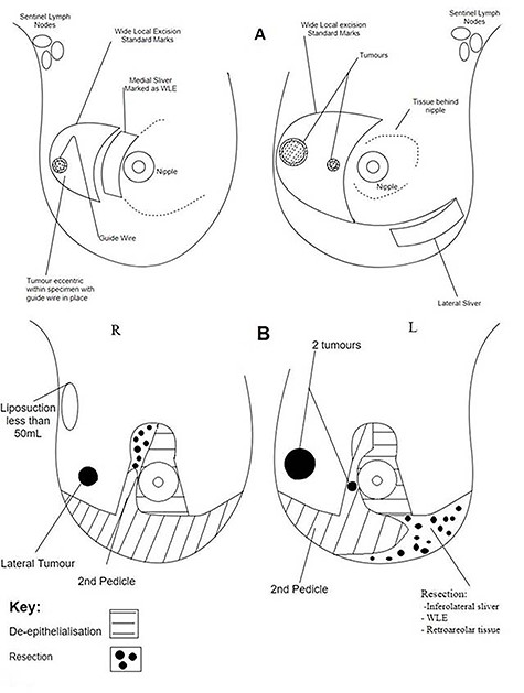 Operative diagrams. (A) Breast surgeon’s operative diagram; (B) plastic surgeon’s operative diagram.
