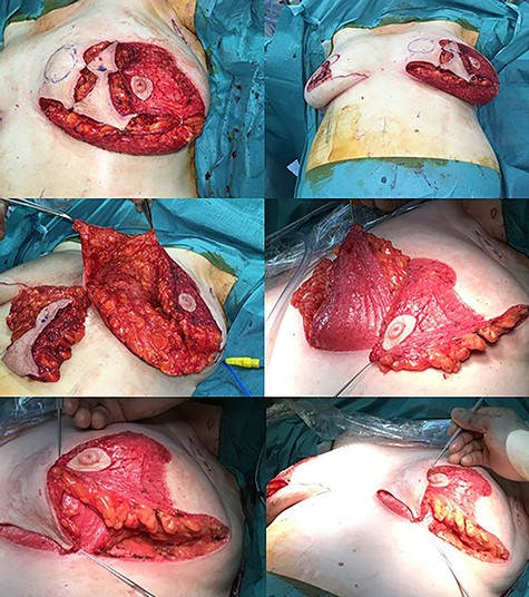 Intraoperative photographs of the left breast. Resection and tissue rearrangement was more complex needing a secondary (totally de-epithelialised) infero-medial dermoglandular pedicle in addition to a supero-lateral nipple-carrying dermoglandular pedicle. A standard superomedial pedicle was used for the right breast (not shown here).