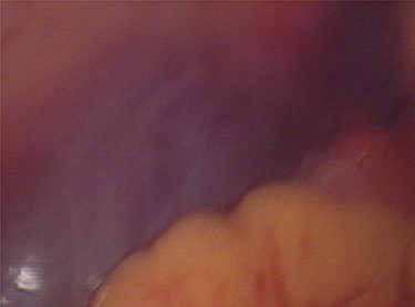 Laparoscopic view of the retroperitoneum hematoma.