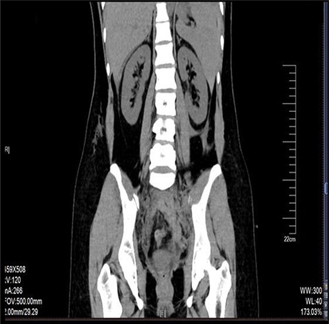 CT scan of the retroperitoneum hematoma.