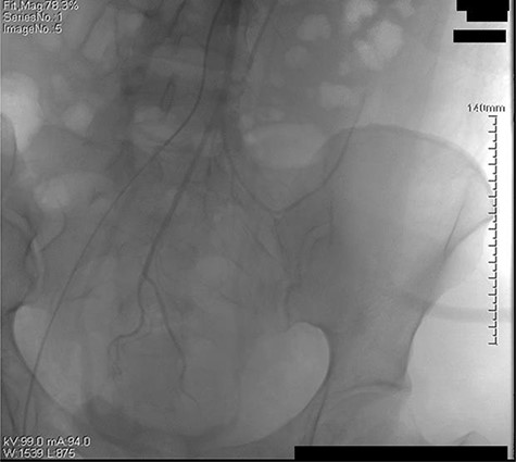 The left iliac artery and inferior mesenteric artery was intact by fluorescence angiography.
